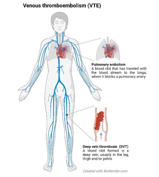 VTE figure overview english.jpeg